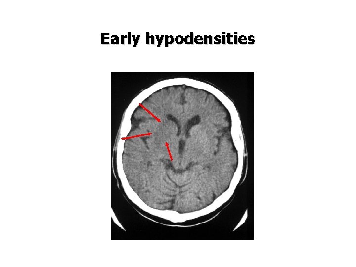 Early hypodensities 
