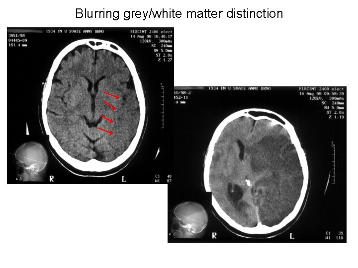 Blurring grey/white matter distinction 