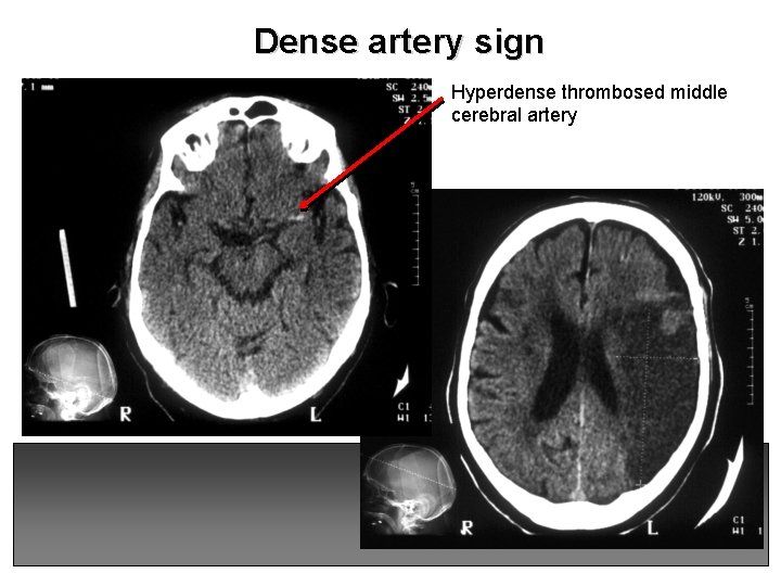 Dense artery sign Hyperdense thrombosed middle cerebral artery 