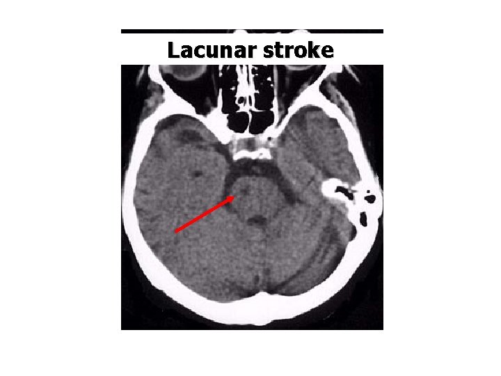 Lacunar stroke 
