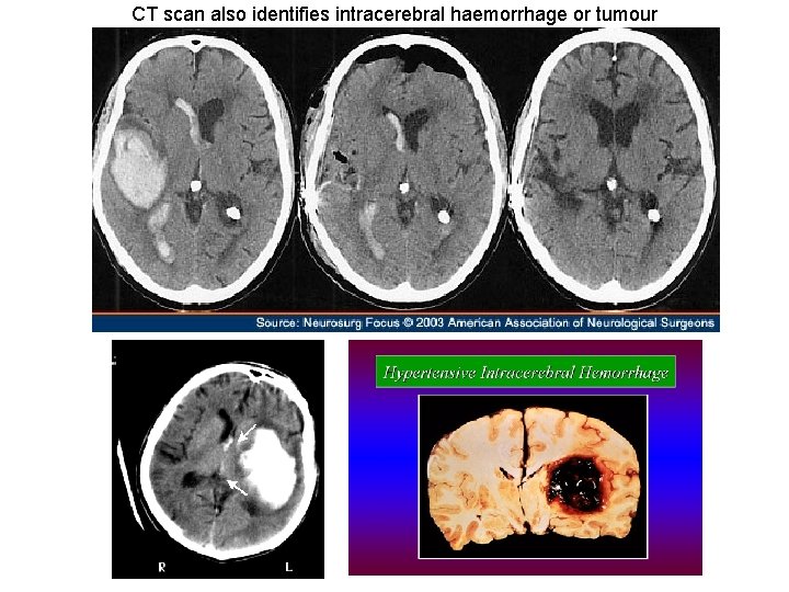 CT scan also identifies intracerebral haemorrhage or tumour 