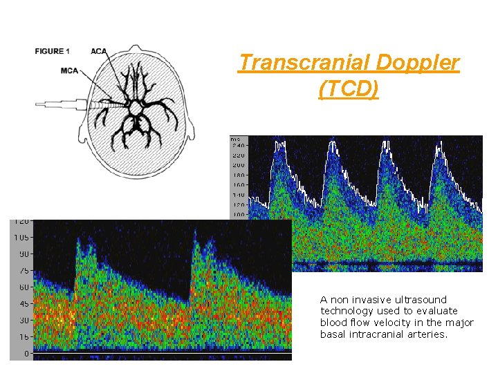 Transcranial Doppler (TCD) A non invasive ultrasound technology used to evaluate blood flow velocity