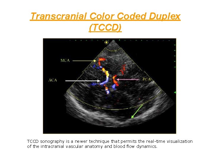 Transcranial Color Coded Duplex (TCCD) TCCD sonography is a newer technique that permits the