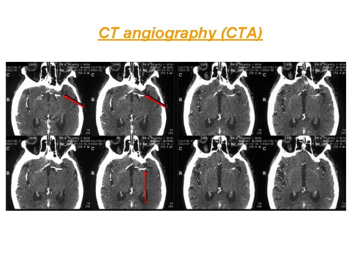 CT angiography (CTA) 