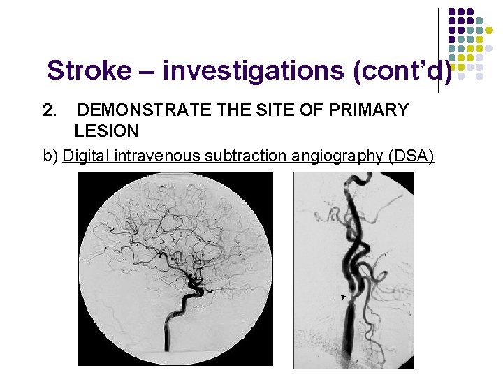 Stroke – investigations (cont’d) 2. DEMONSTRATE THE SITE OF PRIMARY LESION b) Digital intravenous