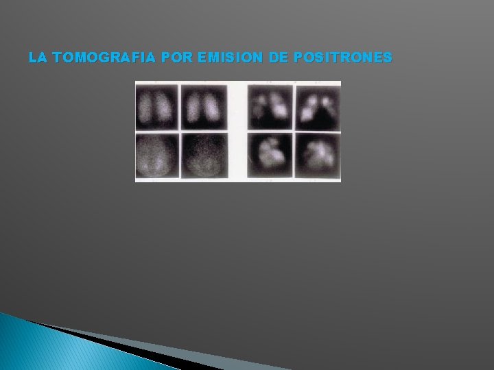LA TOMOGRAFIA POR EMISION DE POSITRONES 