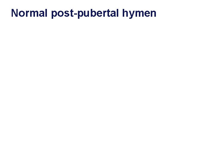 Normal post-pubertal hymen 