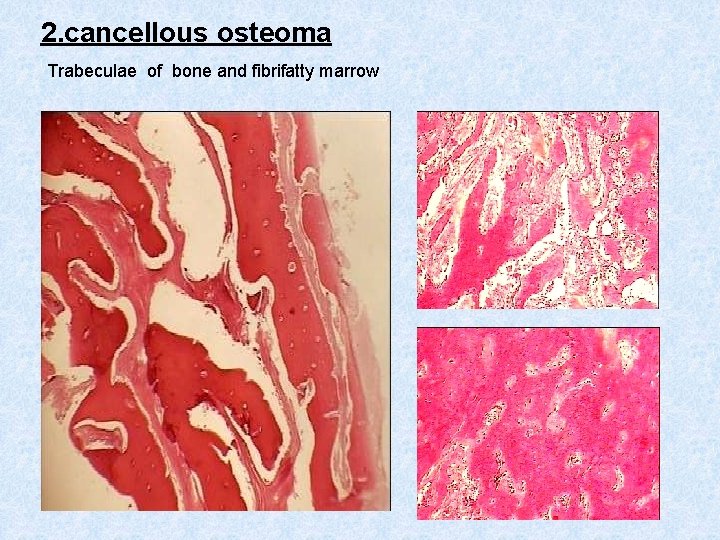 2. cancellous osteoma Trabeculae of bone and fibrifatty marrow 