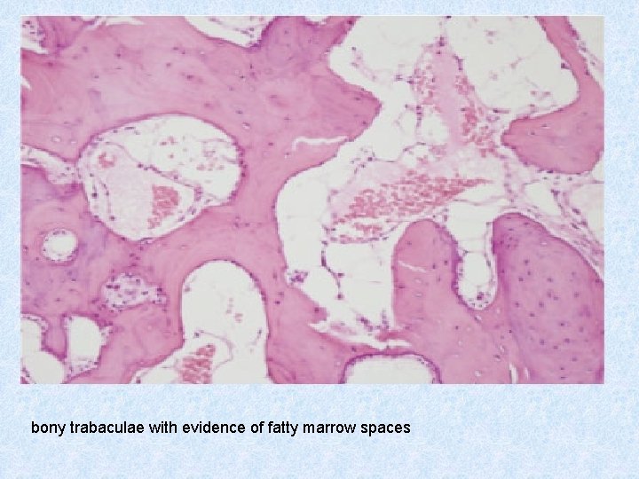 bony trabaculae with evidence of fatty marrow spaces 
