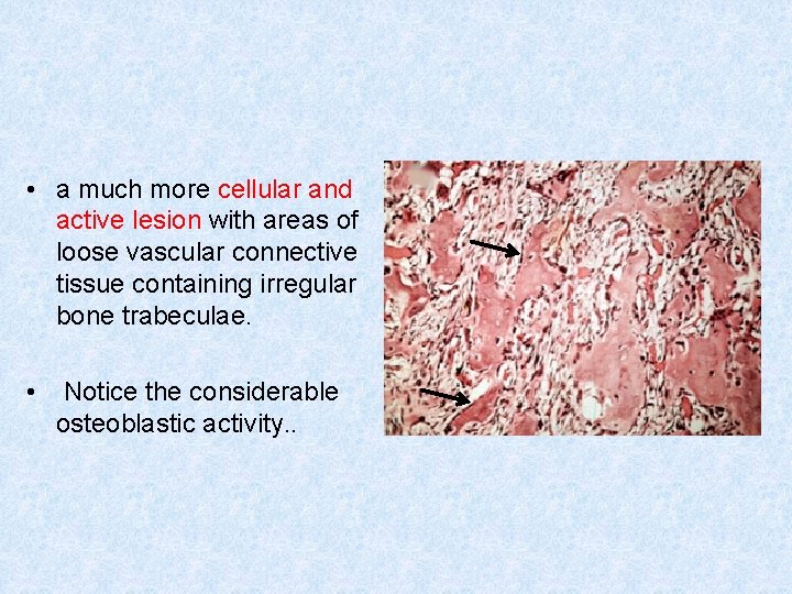  • a much more cellular and active lesion with areas of loose vascular