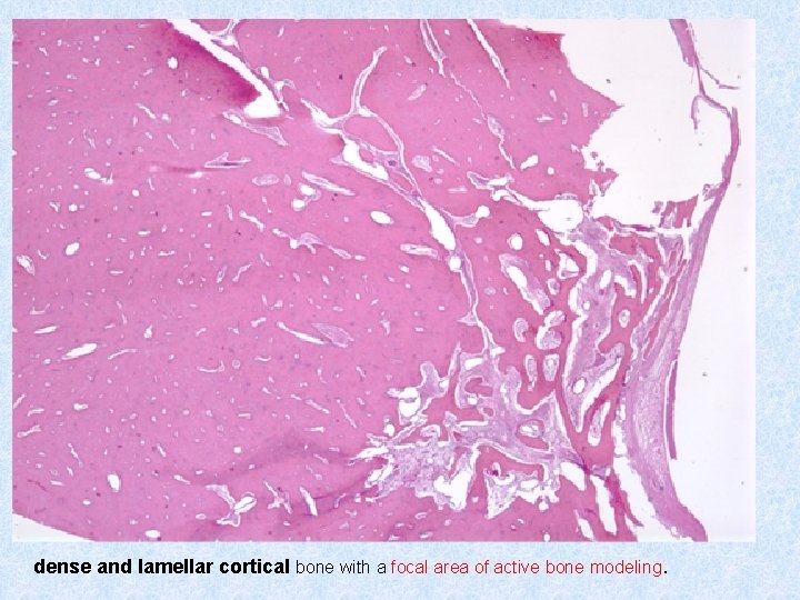 dense and lamellar cortical bone with a focal area of active bone modeling. 