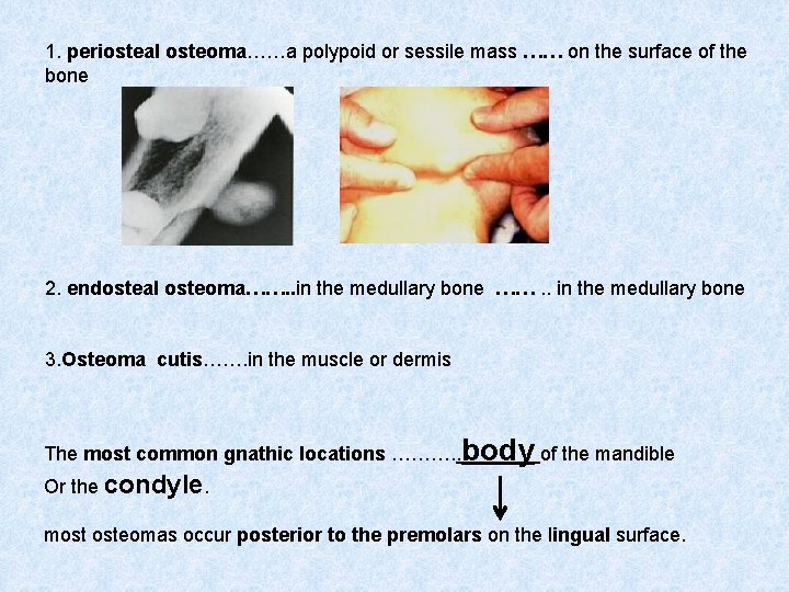 1. periosteal osteoma……a polypoid or sessile mass …… on the surface of the bone