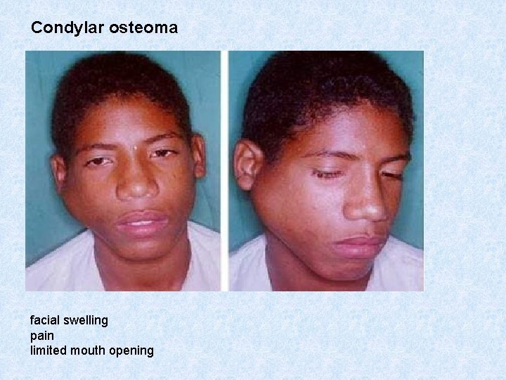 Condylar osteoma facial swelling pain limited mouth opening 