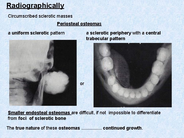 Radiographically Circumscribed sclerotic masses Periosteal osteomas a uniform sclerotic pattern a sclerotic periphery with