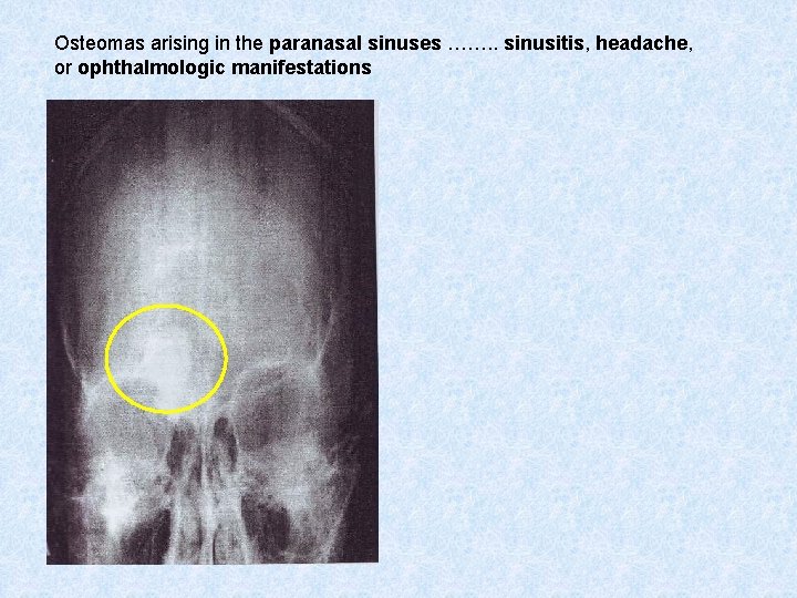 Osteomas arising in the paranasal sinuses ……. . sinusitis, headache, or ophthalmologic manifestations 