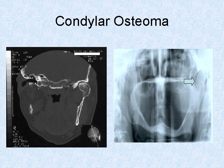 Condylar Osteoma 
