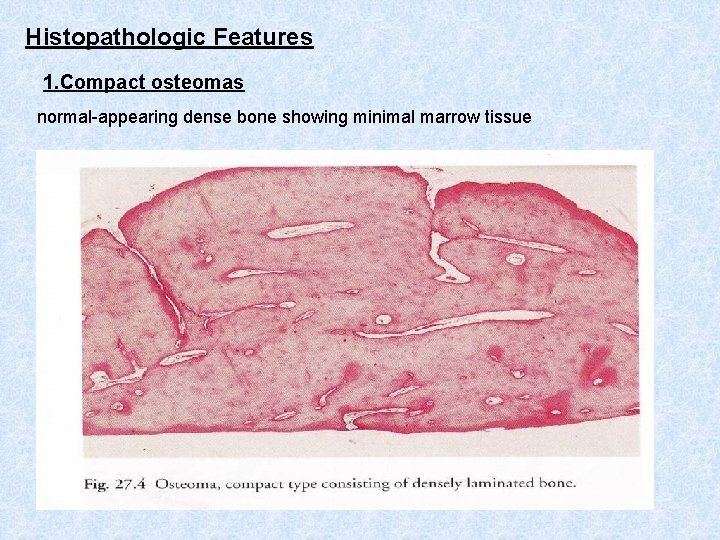 Histopathologic Features 1. Compact osteomas normal-appearing dense bone showing minimal marrow tissue 