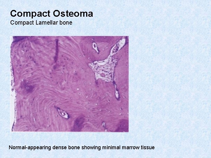 Compact Osteoma Compact Lamellar bone Normal-appearing dense bone showing minimal marrow tissue 