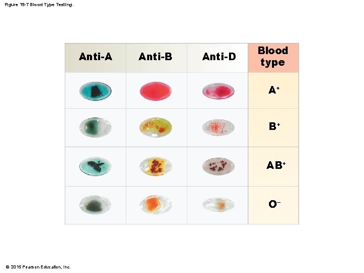 Figure 19 -7 Blood Type Testing. Anti-A Anti-B Anti-D Blood type A+ B+ AB+
