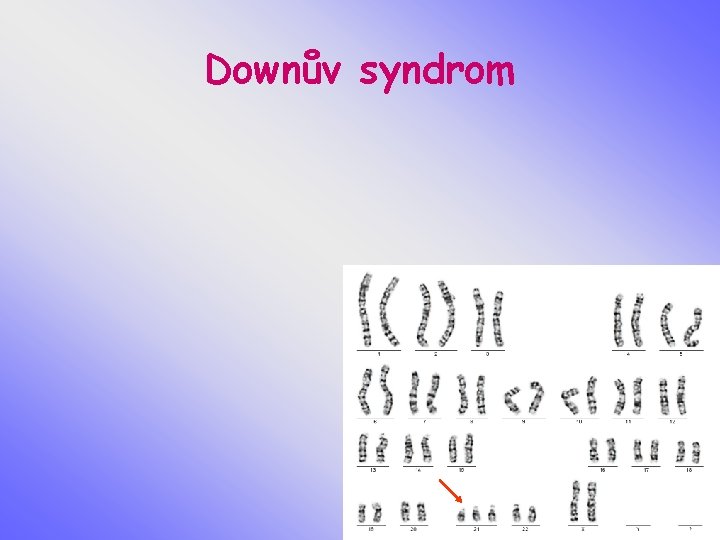 Downův syndrom 