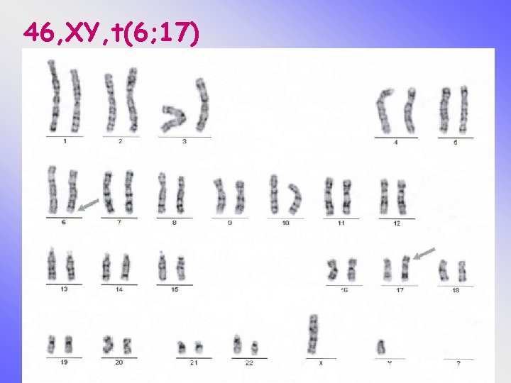 46, XY, t(6; 17) 