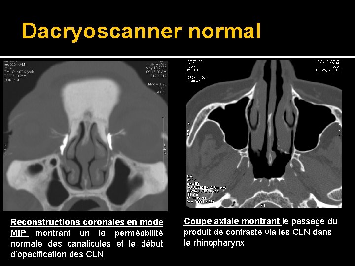 Dacryoscanner normal Reconstructions coronales en mode MIP montrant un la perméabilité normale des canalicules