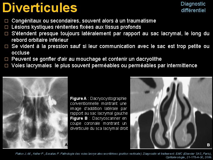 Diverticules Diagnostic différentiel Congénitaux ou secondaires, souvent alors à un traumatisme Lésions kystiques rénitentes