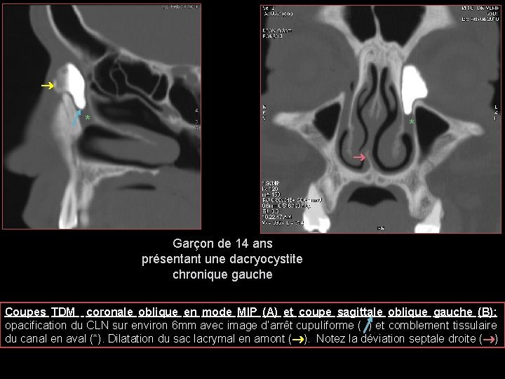  * * Garçon de 14 ans présentant une dacryocystite chronique gauche Coupes TDM