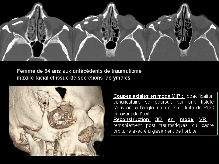 Femme de 54 ans aux antécédents de traumatisme maxillo facial et issue de sécrétions