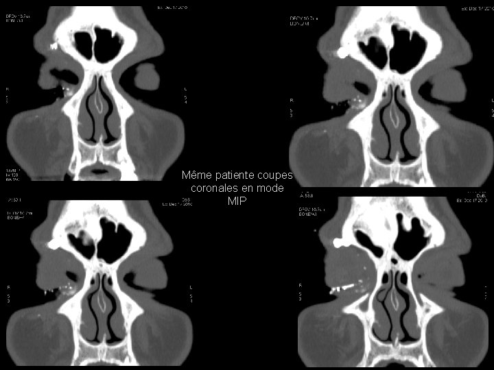 Même patiente coupes coronales en mode MIP 