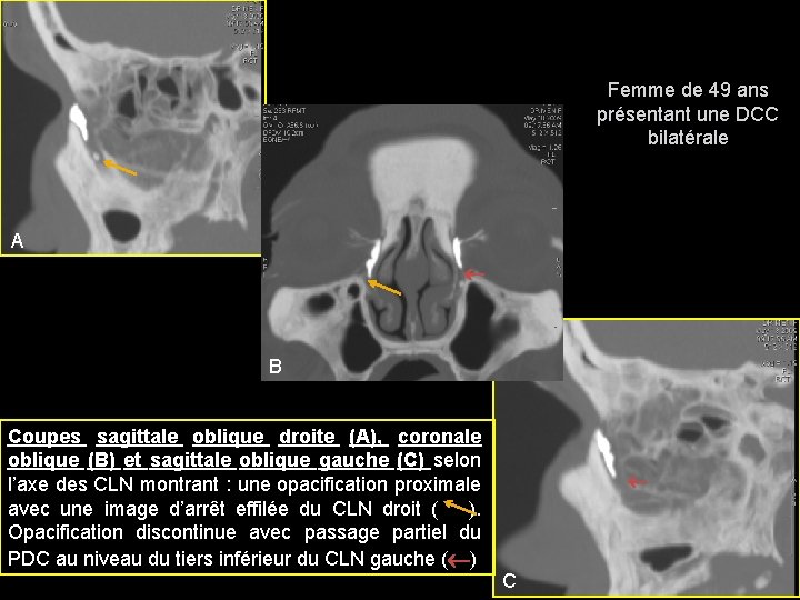 Femme de 49 ans présentant une DCC bilatérale A B Coupes sagittale oblique droite