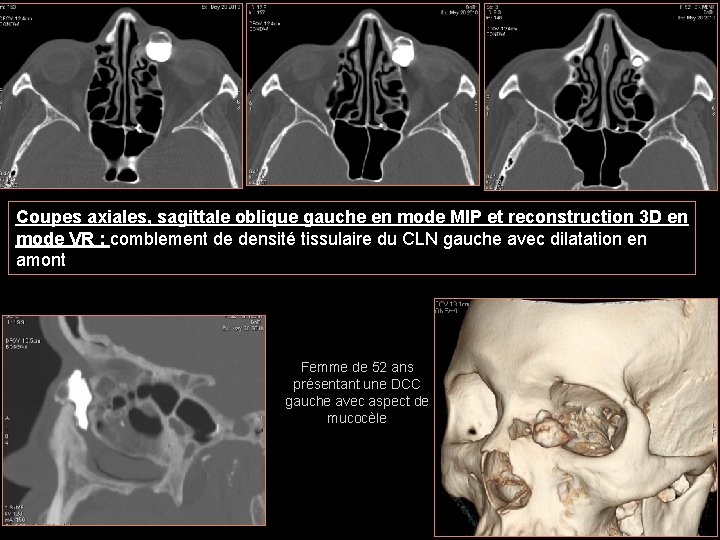 Coupes axiales, sagittale oblique gauche en mode MIP et reconstruction 3 D en mode