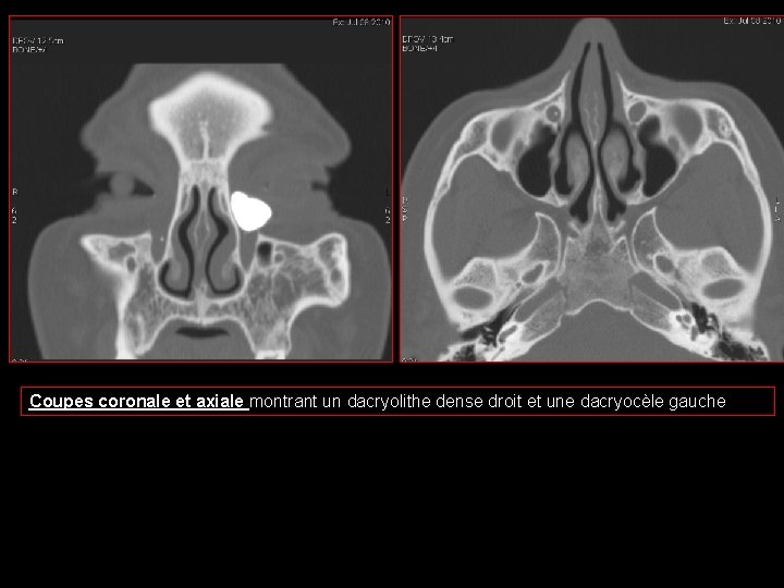 Coupes coronale et axiale montrant un dacryolithe dense droit et une dacryocèle gauche 