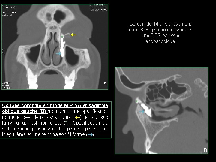 * Garcon de 14 ans présentant une DCR gauche indication à une DCR par