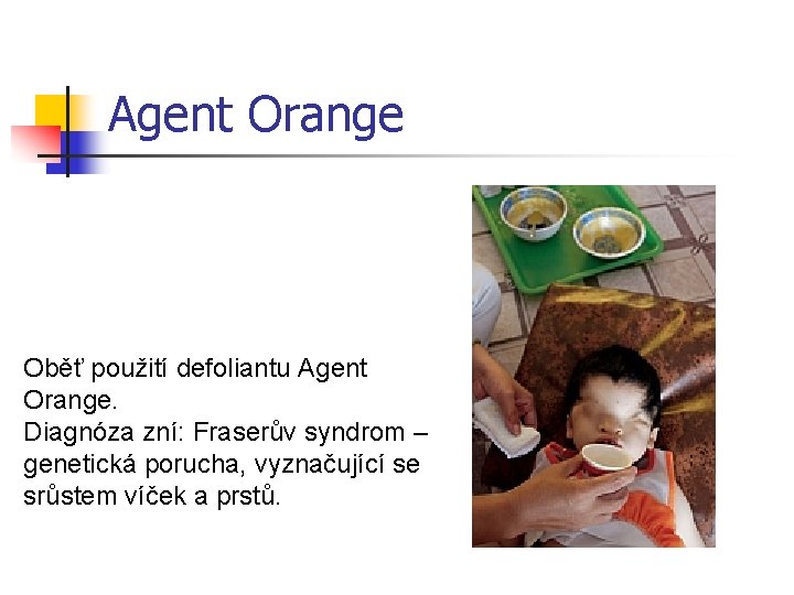Agent Orange Oběť použití defoliantu Agent Orange. Diagnóza zní: Fraserův syndrom – genetická porucha,
