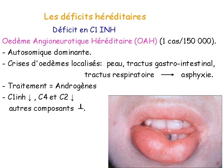 Les déficits héréditaires Déficit en C 1 INH Oedème Angioneurotique Héréditaire (OAH) (1 cas/150