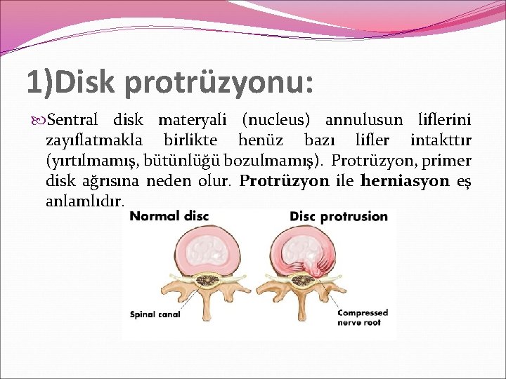 1)Disk protrüzyonu: Sentral disk materyali (nucleus) annulusun liflerini zayıflatmakla birlikte henüz bazı lifler intakttır