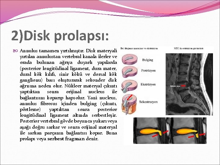 2)Disk prolapsı: Annulus tamamen yırtılmıştır. Disk materyali yırtılan annulustan vertebral kanala ilerler ve orada