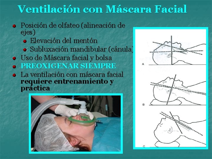 Ventilación con Máscara Facial Posición de olfateo (alineación de ejes) Elevación del mentón Subluxación