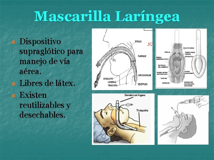 Mascarilla Laríngea n n n Dispositivo supraglótico para manejo de vía aérea. Libres de