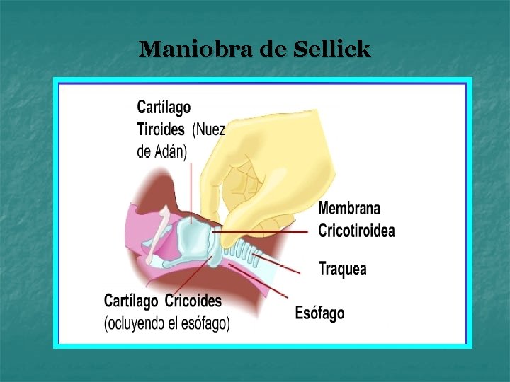 Maniobra de Sellick 