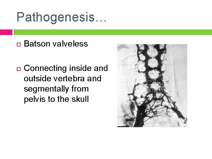 Pathogenesis… Batson valveless Connecting inside and outside vertebra and segmentally from pelvis to the
