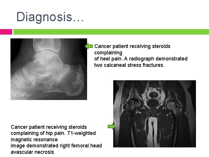 Diagnosis… Cancer patient receiving steroids complaining of heel pain. A radiograph demonstrated two calcaneal