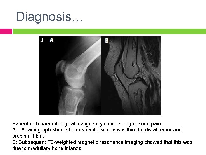 Diagnosis… Patient with haematological malignancy complaining of knee pain. A: A radiograph showed non-specific