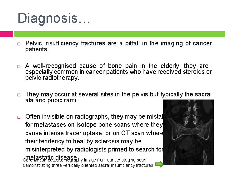 Diagnosis… Pelvic insufficiency fractures are a pitfall in the imaging of cancer patients. A