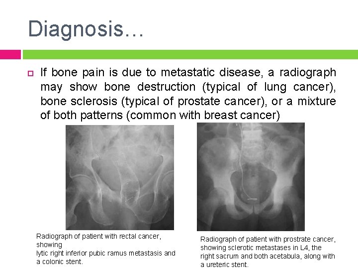 Diagnosis… If bone pain is due to metastatic disease, a radiograph may show bone