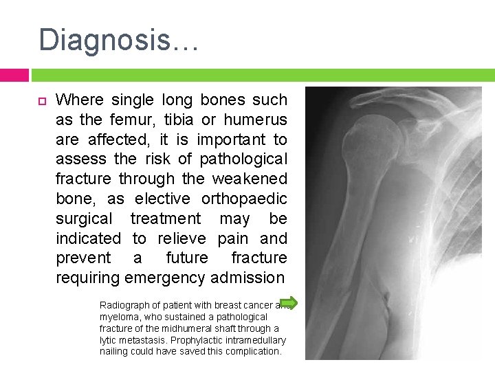 Diagnosis… Where single long bones such as the femur, tibia or humerus are affected,