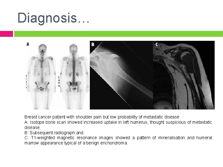 Diagnosis… Breast cancer patient with shoulder pain but low probability of metastatic disease. A: