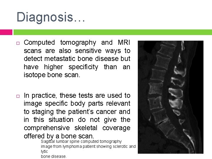 Diagnosis… Computed tomography and MRI scans are also sensitive ways to detect metastatic bone