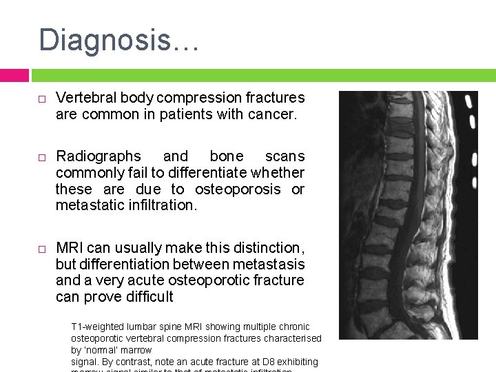 Diagnosis… Vertebral body compression fractures are common in patients with cancer. Radiographs and bone